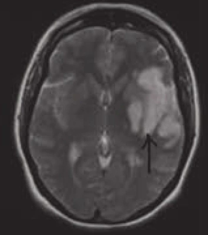 Infarktová tkáň na T2 vážených obrazech MRI.