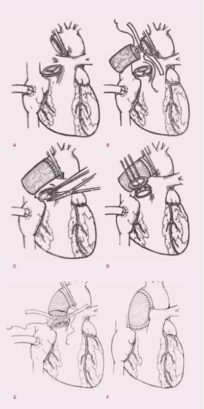 Náhrada aortální chlopně a ascendentní aorty protézami.