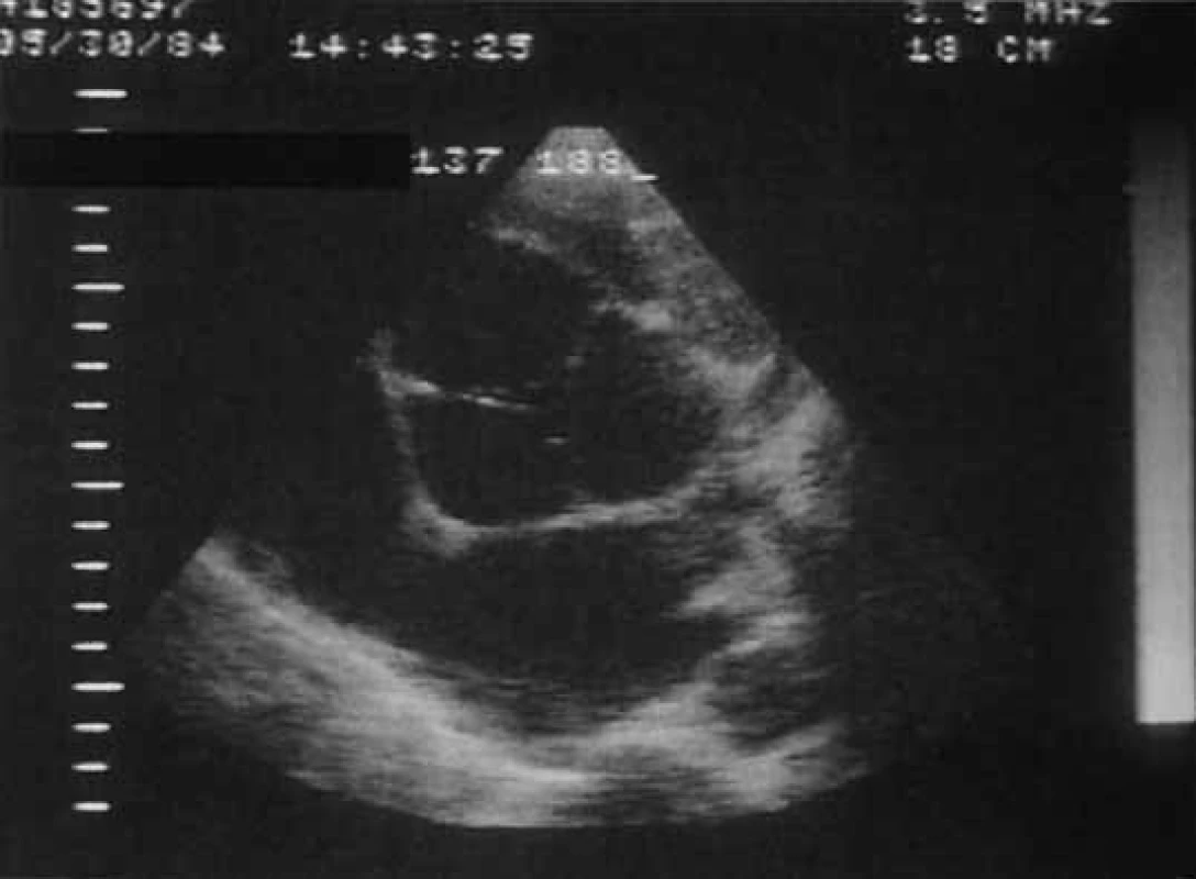 (a) Parasternální pohled v dlouhé ose u pacienta s aneuryzmatickou dilatací kořene aorty sdruženou s Marfanovým syndromem. Vidíme kompletní ztrátu integrity supravalvulární hrany (sinu tubulární junkce). Proximální aorta má průměr vyšší než 8 cm. (b) Výseč parasternálního pohledu v krátké ose ukazuje chlopeň se 3 cípy a selhání apozice okrajů cípů.