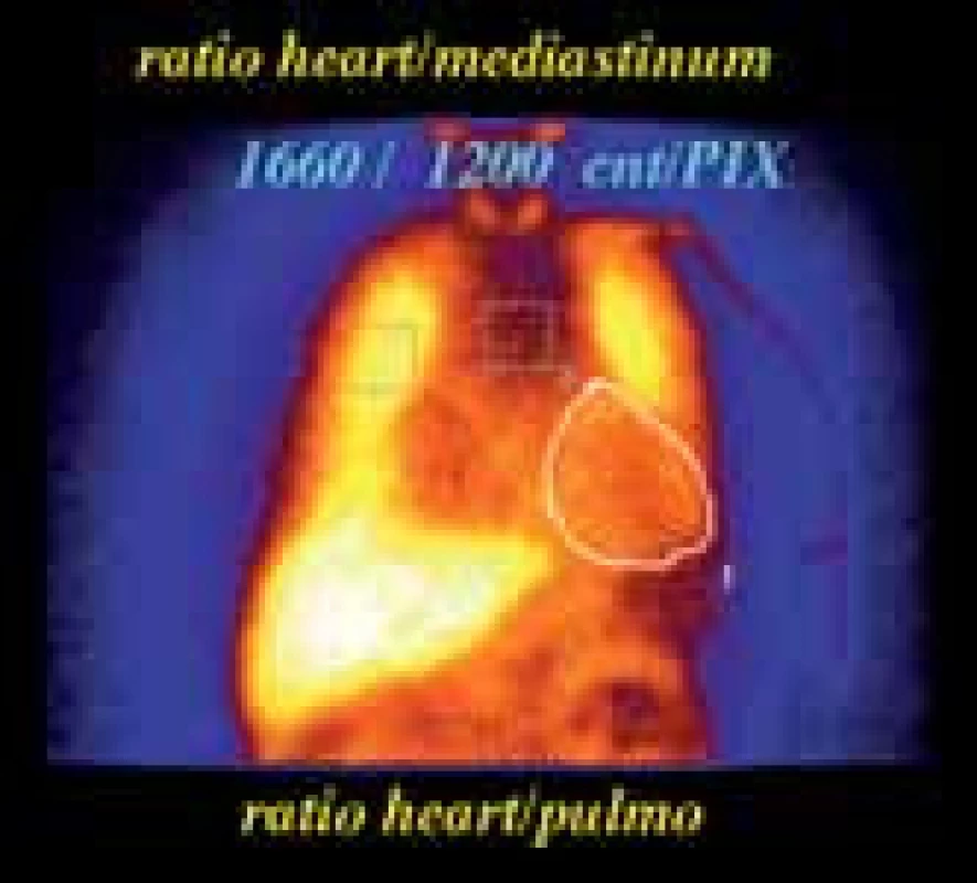 Zobrazení adrenergní inervace a počítání poměrů srdce versus mediastinum či plíce u SPECT scintigrafie. 123I – metaiodobenzylguanidinu (MIBG) u pacienta se známkami srdečního selhání.