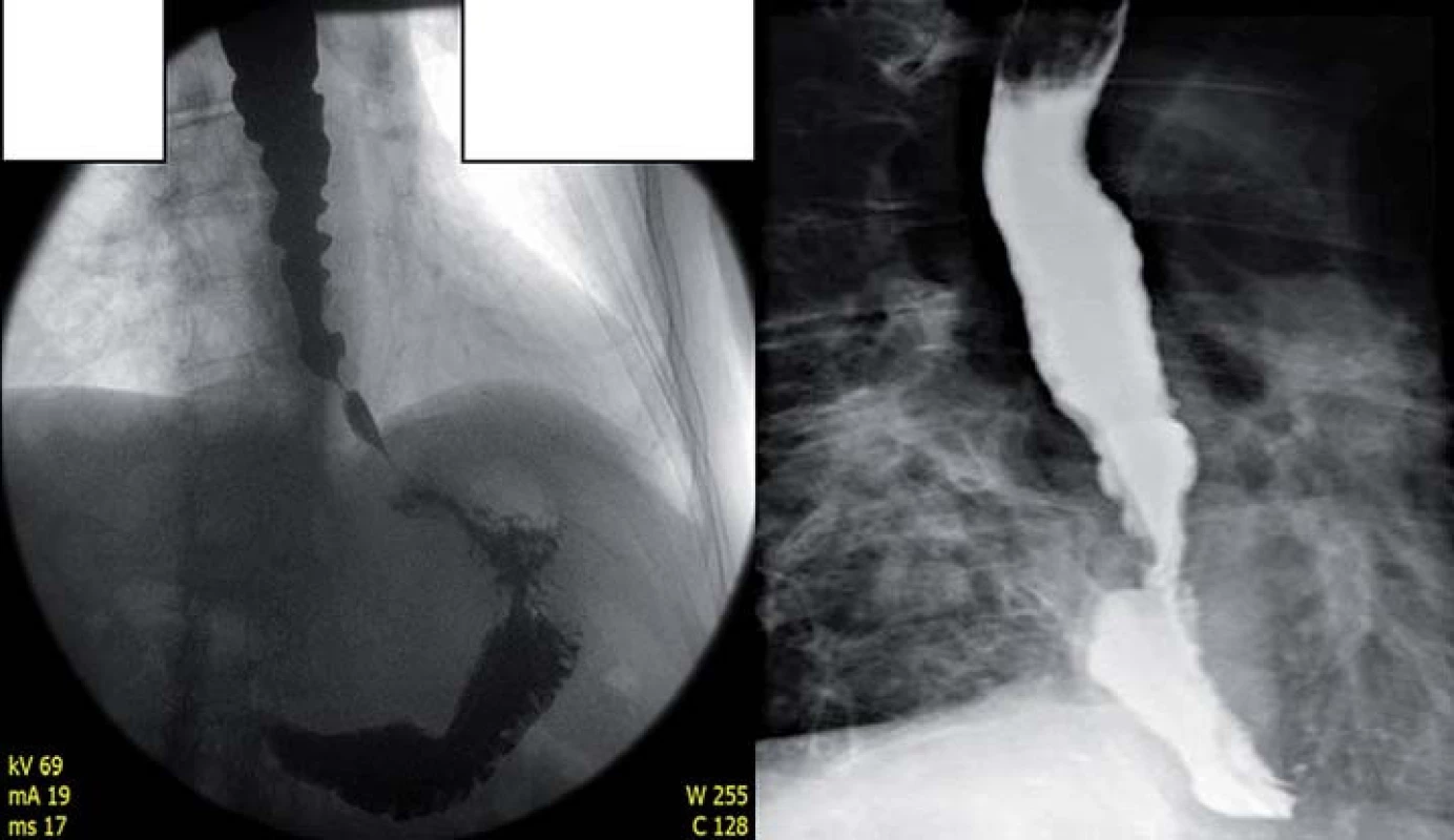 RTG obrázek pacienta s achalázií III typu se spazmy před POEM (vlevo) a po POEM (vpravo). Rok po POEM je pacient zcela asymptomatický.