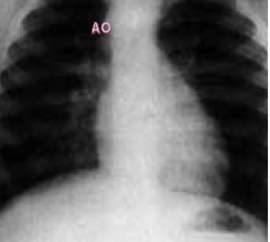 Skiagram ukazující pravostranný aortální oblouk.

