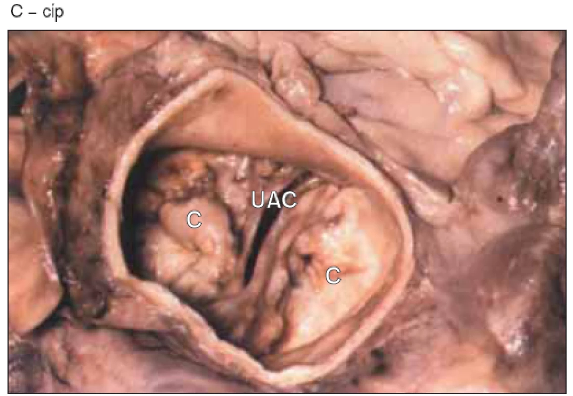 Kalcifikovaná bikuspidální aortální chlopeň. Transverzální řez kořenem aorty, otvor chlopně mezi oběma cípy. Na každém cípu jsou hroudy kalcifikací.