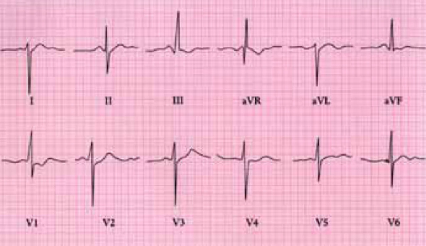 EKG u Fallotovy tetralogie ukazuje hypertrofii pravé komory.