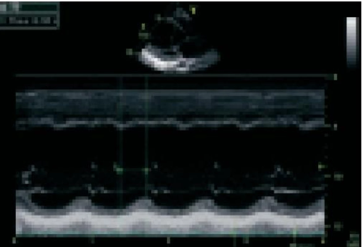 Významná asynchronie mezi vrcholem kontrakce septa a zadní stěny levé komory zjištěná M-mode echokardiografií (časový rozdíl činí 350 ms).