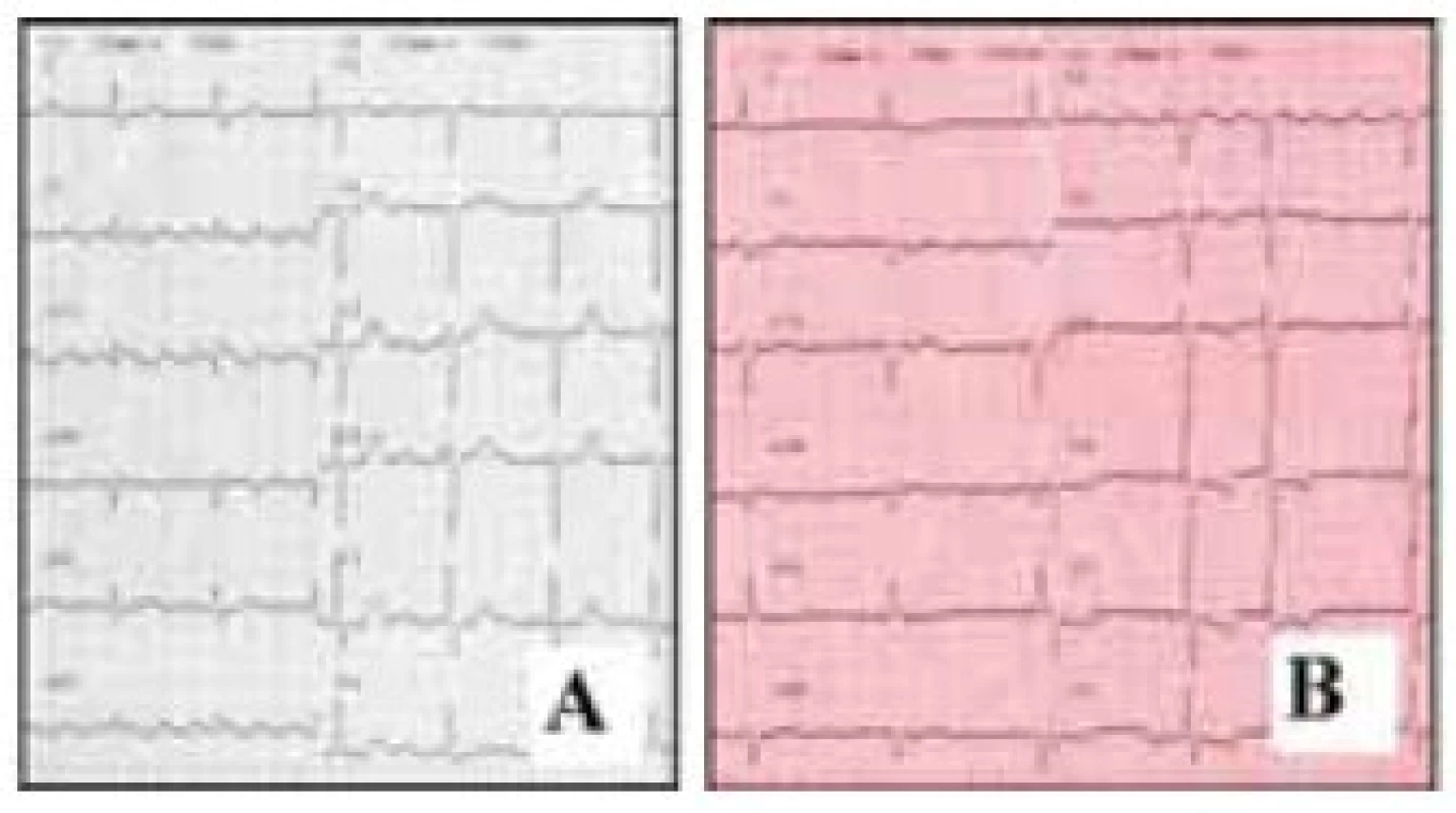 Povrchové EKG u typického flutteru síní. A – counterclockwise, B – clockwise.