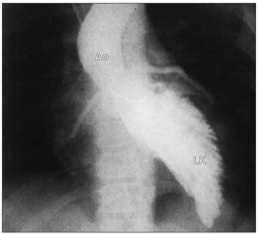 Angiogram levé komory v pravé přední šikmé projekci u aortální stenózy ukazuje velkou hypertrofii levé komory.