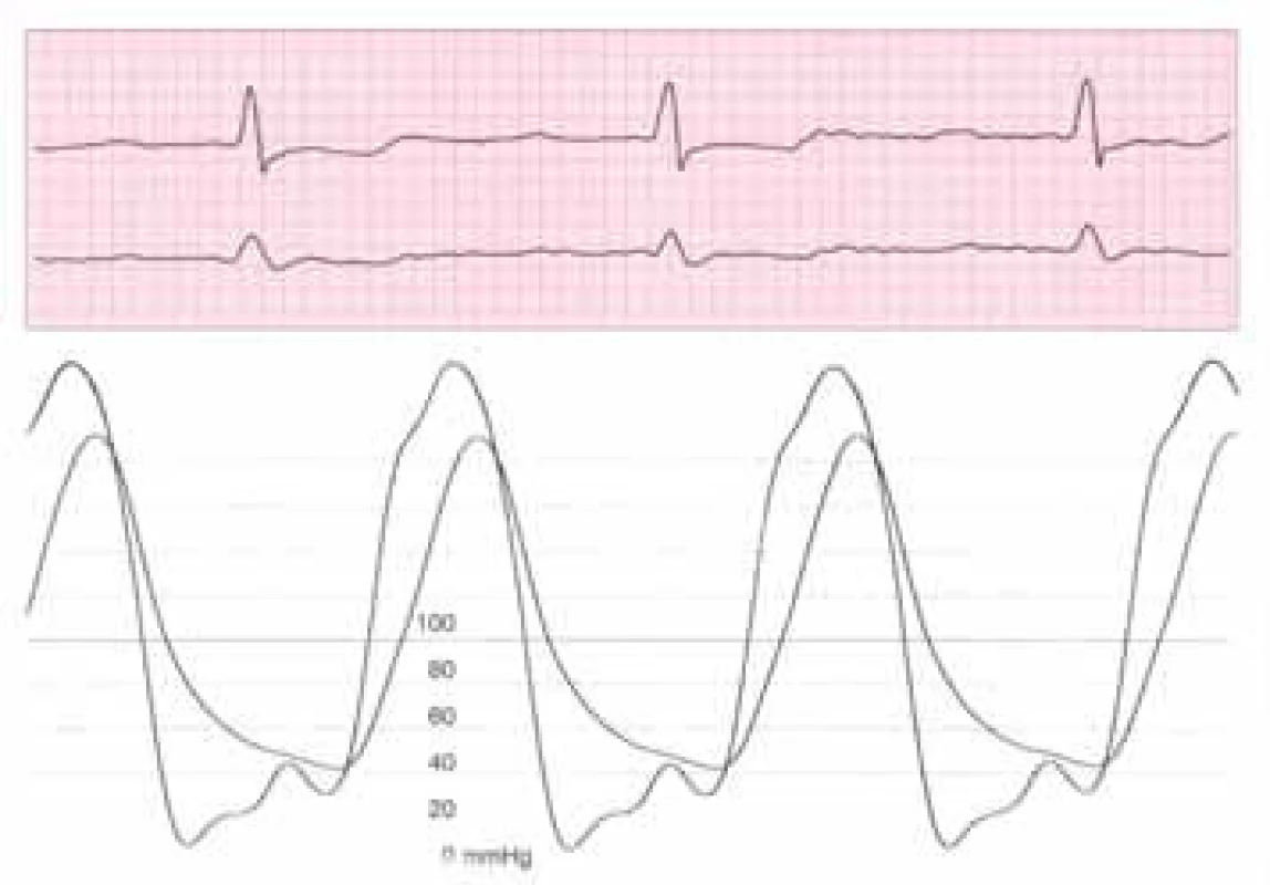Současný záznam aortálního a levokomorového tlaku u pacienta s významnou chronickou aortální regurgitací: zvýšený enddiastolický tlak v levé komoře a nízký aortální diastolický tlak.