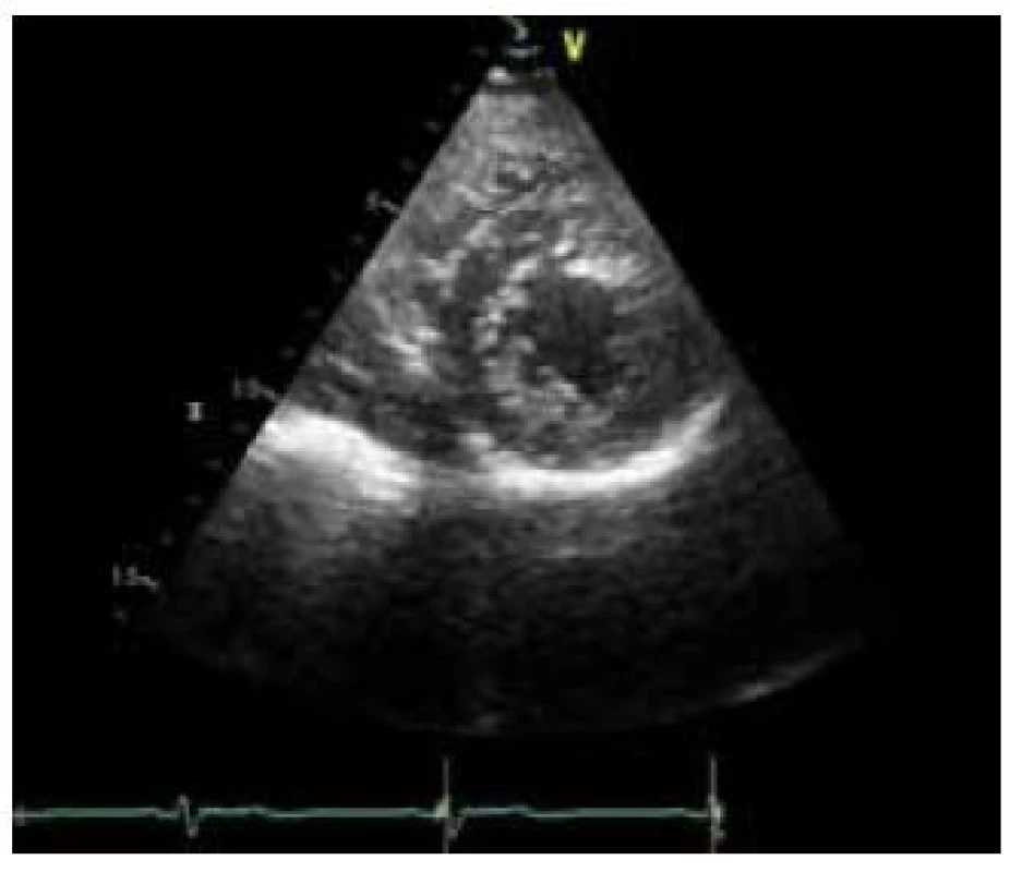 Echokardiografický obraz nekompaktní kardiomyopatie – parasternální krátká osa na konci systoly, poměr nekompaktní ke kompaktní vrstvě je &gt; 2.