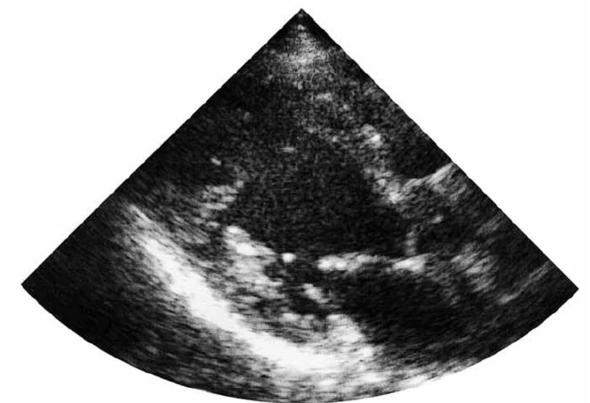 Transtorakální echokardiografie (11/2010) – parasternální projekce.