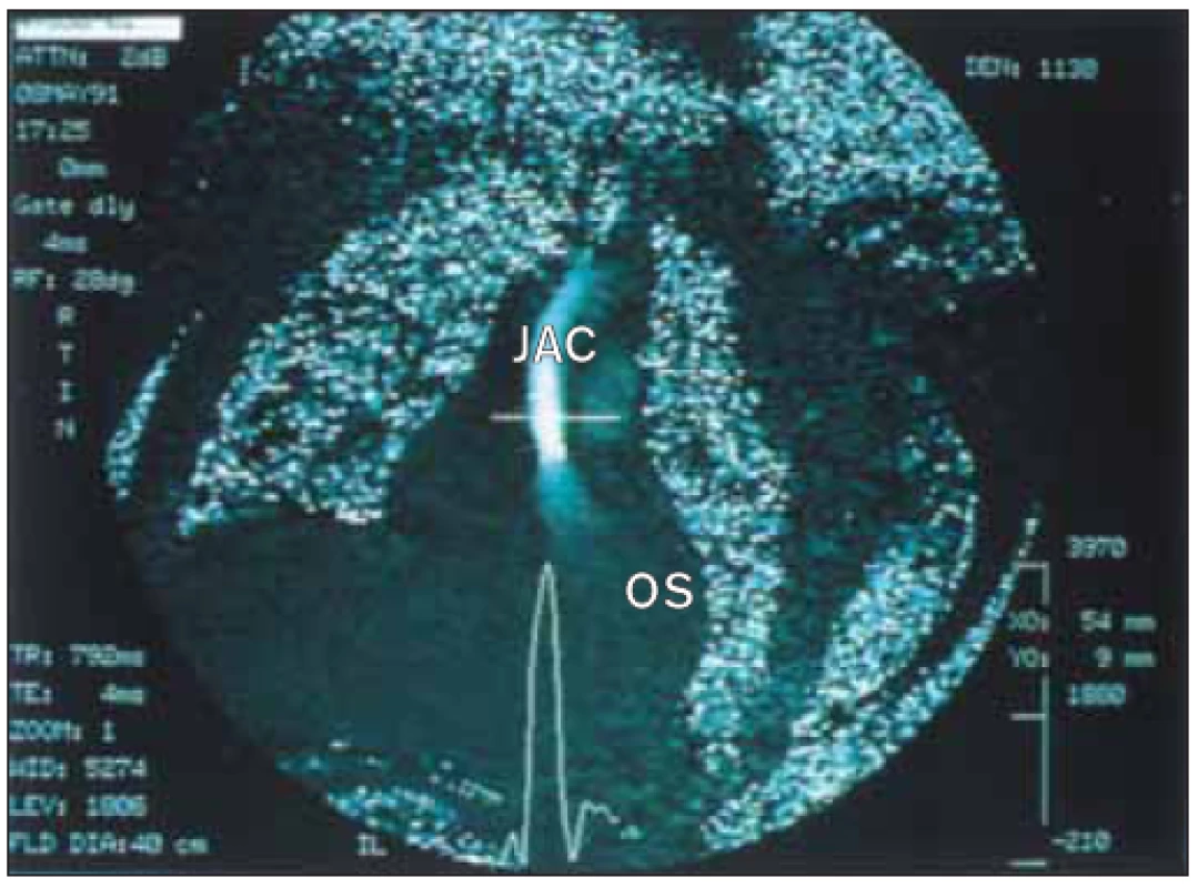 Mapování rychlosti u aortální stenózy magnetickou rezonancí. Zobrazovací rovina byla otočena šikmo a ukazuje jet v rámečku vertikálně. Měření vrcholové rychlosti aortálního jetu dává téměř 4m/s,
což se rovná tlakovému gradientu 64 mmHg.