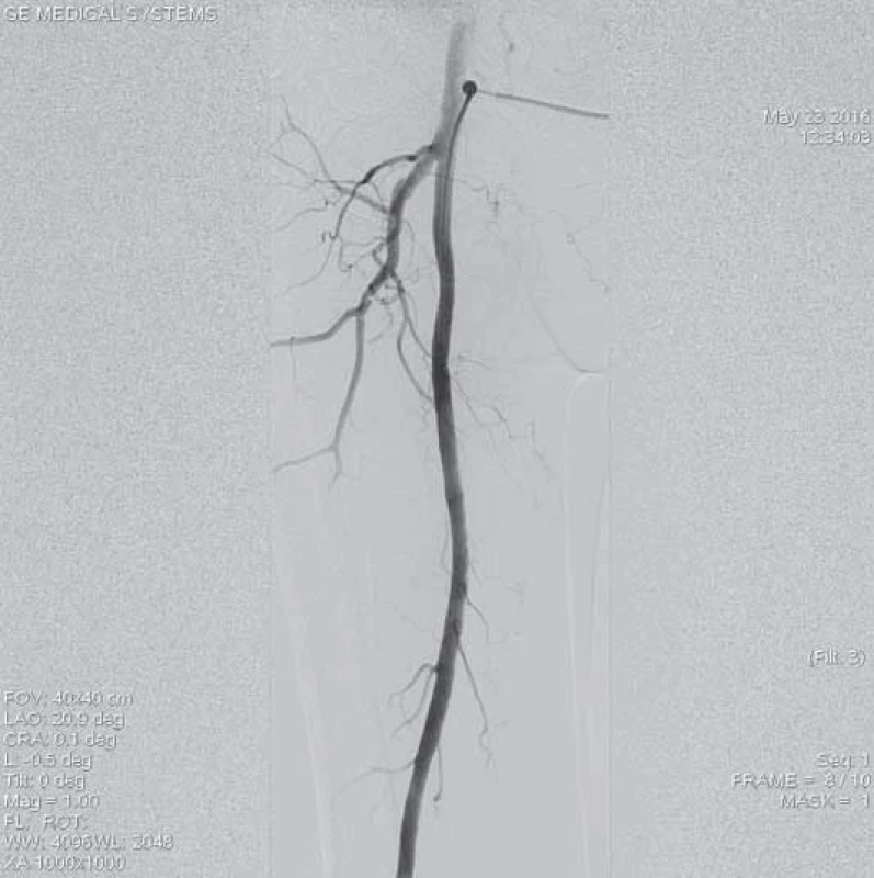 Angiografie levé povrchní femorální tepny, která je bez známek výraznějšího aterosklerotického postižení.