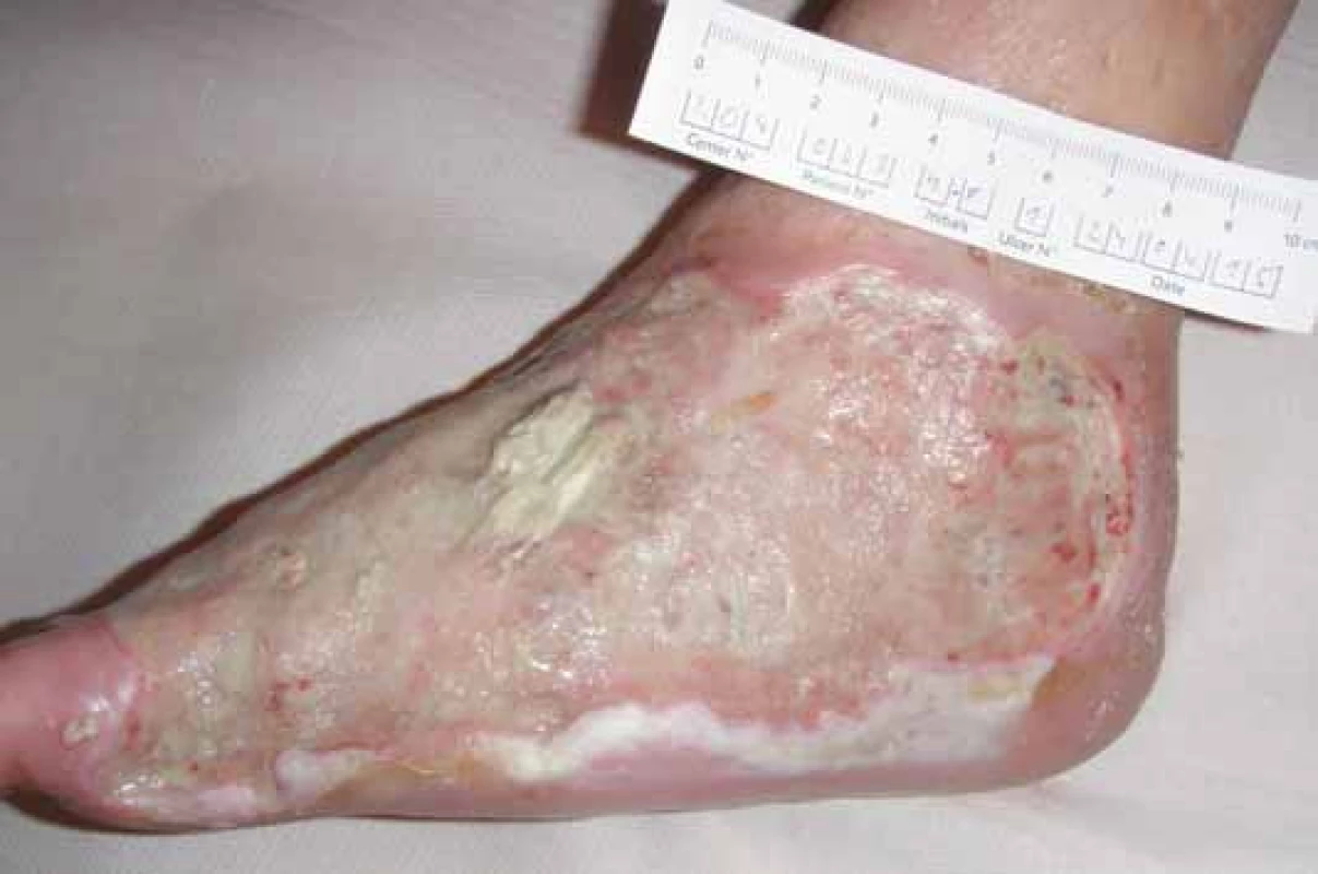 Infikovaný defekt po amputaci IV. a V. prstce.