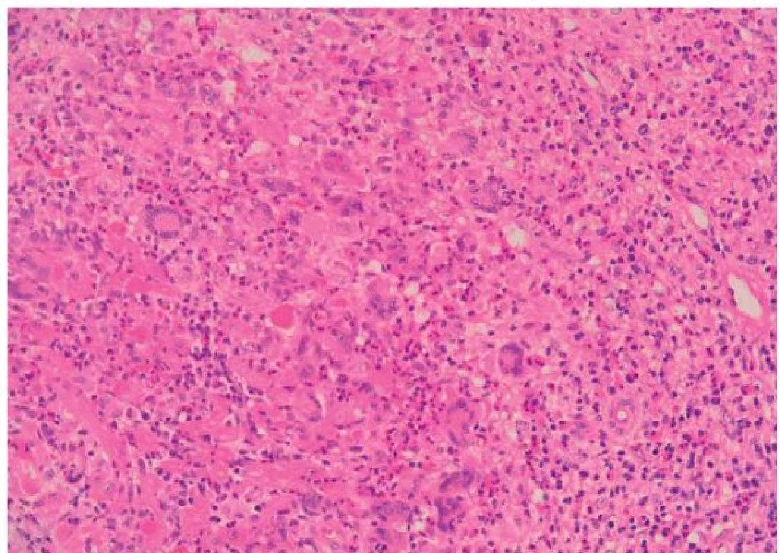 Histologie obrovskobuněčné myokarditidy (barvení HE, původní zvětšení 200×). Denzní infiltrát se smíšenou zánětlivou celulizací, jež je složena především z lymfocytů a makrofágů, přítomny jsou také četné eozinofily a neutrofily.