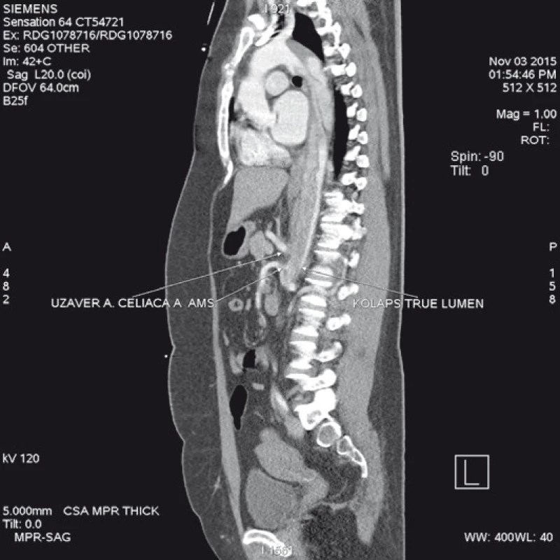 CT angiografie zobrazující disekci aorty typ B začínající za levou podklíčkovou tepnou, 
s kolapsem pravého lumen v oblasti břišní aorty a útlaku odstupů a. celiaca a horní mezenterické tepny.
