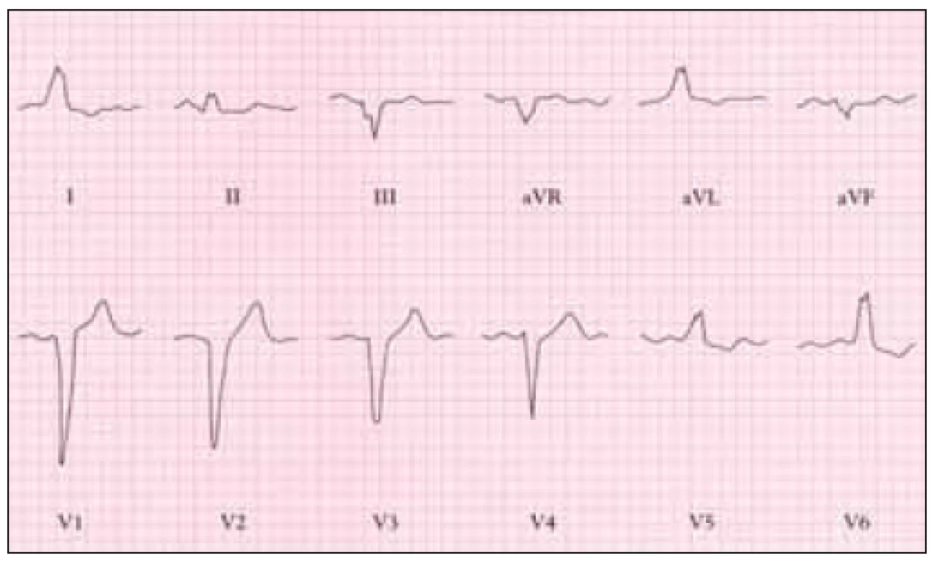 EKG u pacienta se stenózou aorty, blokáda levého raménka.