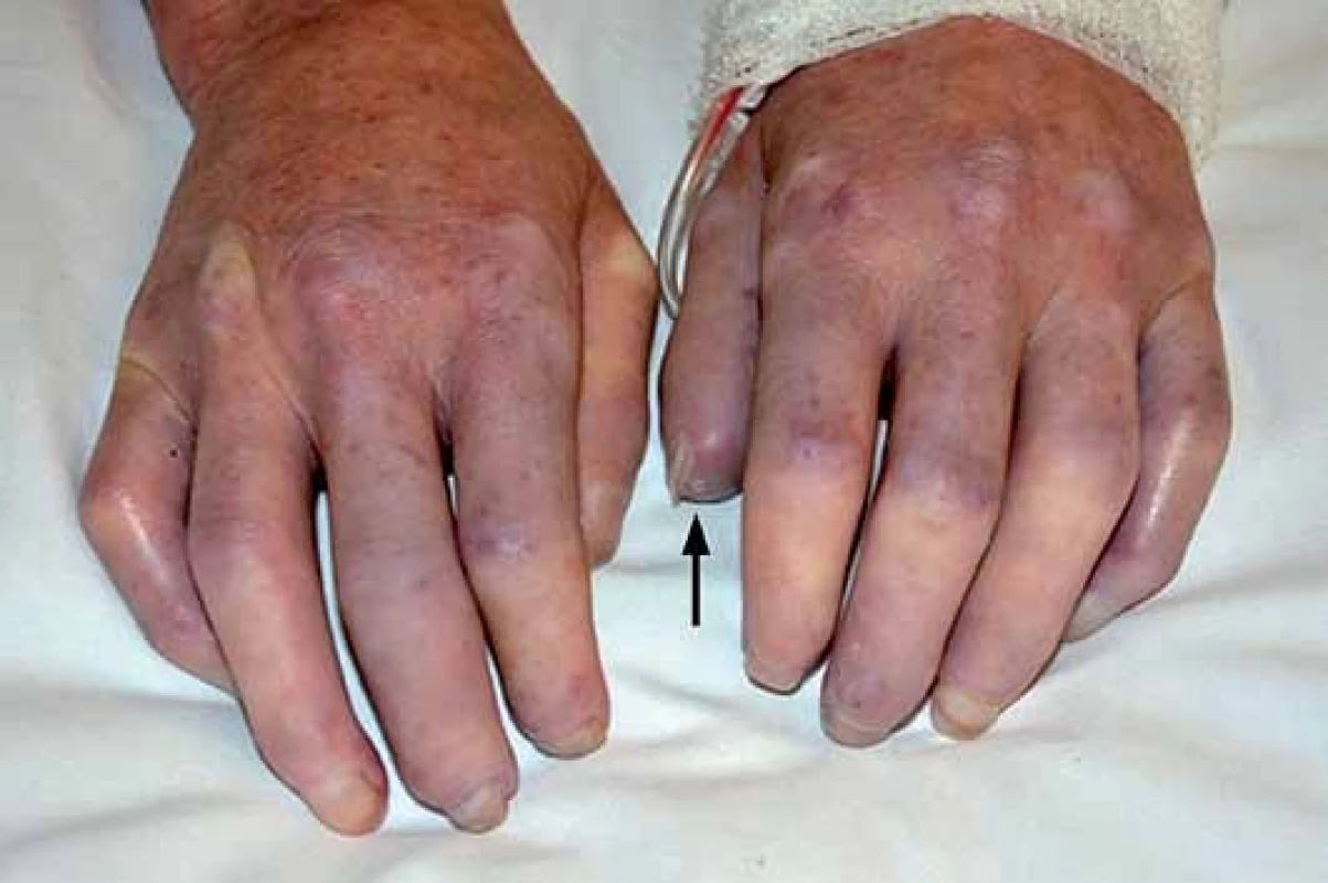 Sklerodaktylie, jamkovité jizvičky na špičkách prstů (↑).