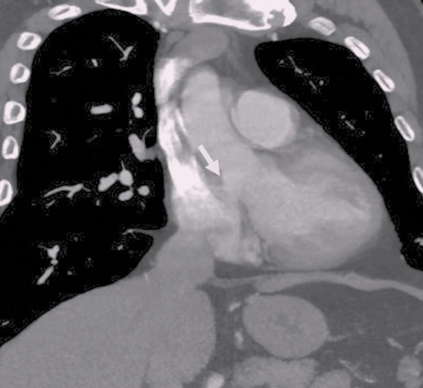 MDCT angiografie hrudní aorty verifikuje zkrat mezi aortou a pravou síní (šipka).