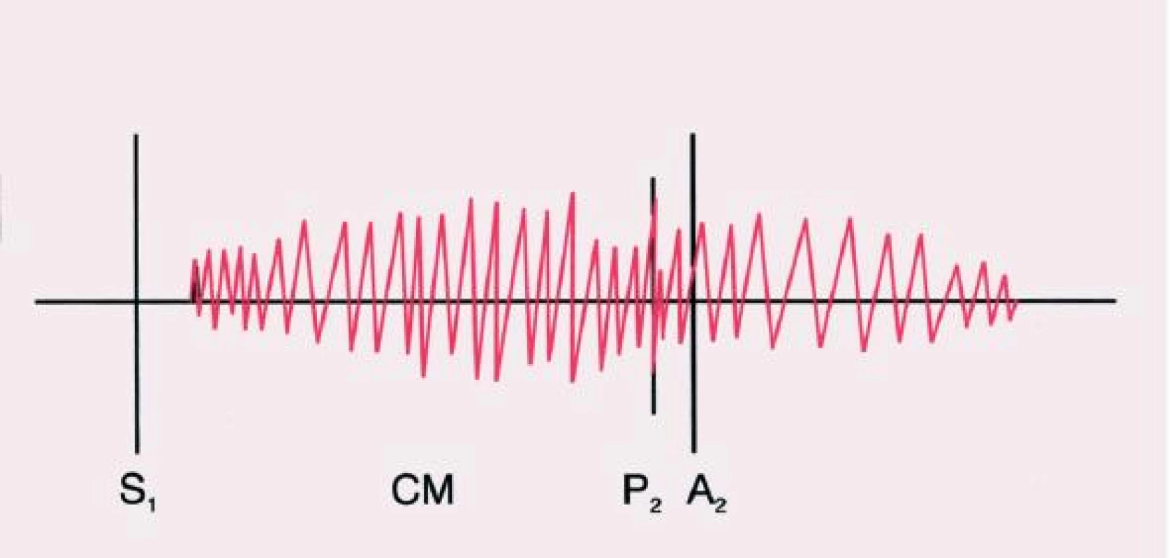 Kontinuální šelest během systoly a diastoly. Druhá ozva může být paradoxně rozštěpena.