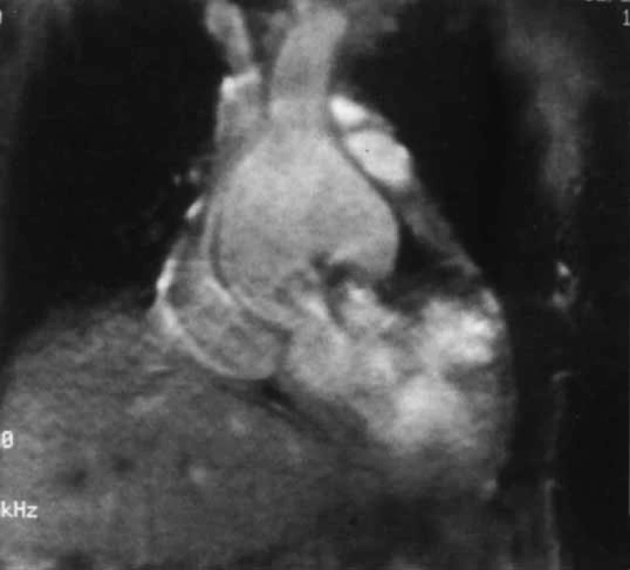 Sagitální cine-MR ascendentní aorty ukazuje u pacienta s Marfanovým syndromem hruškovité rozšíření měřící 7 cm.
