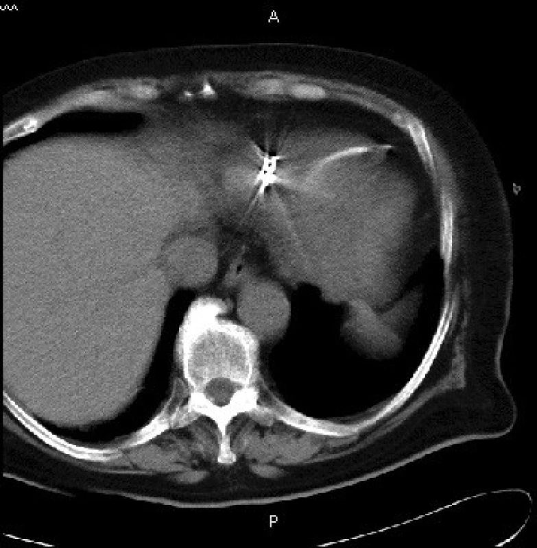 CT-snímek; hrot defibrilační elektrody mimo konturu srdeční.