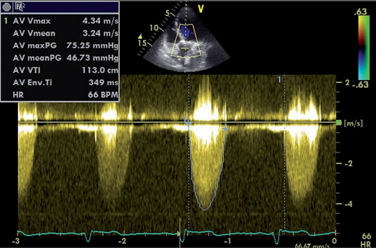 Zobrazení průtoku přes těžkou aortální stenózu CW Dopplerem.