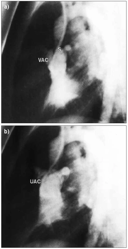 Boční aortogram u supravalvulární stenózy aorty. (a) V systole je stenóza zřetelně viditelná nad aortální chlopní. Můžeme vidět, že její cípy téměř okludují koronární tepny. (b) V diastole se koronární cípy pohnuly pryč od zřetelně dilatovaných koronárních arterií, které jsou ve vysoké tlakové zóně mezi chlopní a supravalvulární stenózou.