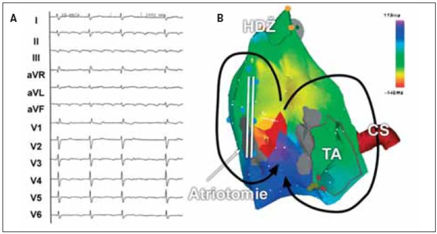 (A) EKG-záznam síňové tachykardie s měnlivým AV-převodem u pacienta po korekci vrozené srdeční vady. Morfologie arytmie na EKG nevylučuje typický flutter síní. (B) Elektroanatomická mapa pravé síně v předozadní projekci při síňové tachykardii. Arytmie je tvořena 2 okruhy, z nichž jeden krouží okolo jizvy po atriotomii na laterální stěně pravé síně a druhý okolo trikuspidálního ústí. Oba okruhy mají společný istmus mezi jizvou po atriotomii a trikuspidálním ústím.