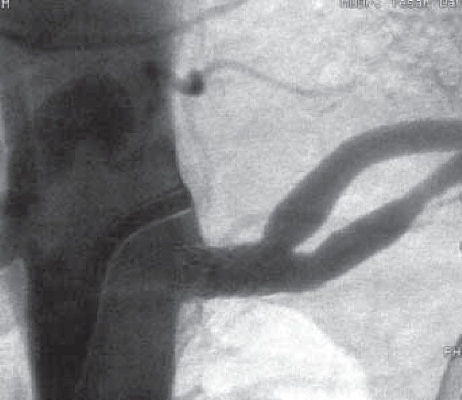 Angiogram původně stenotické renální tepny po implantaci stentu.