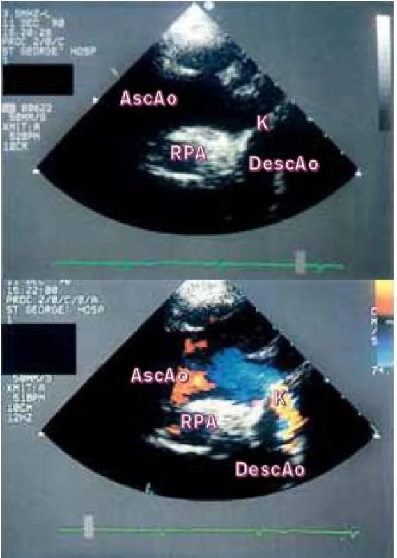 (a) Suprasternální 2D-pohled ukazuje aortální oblouk a jeho tepny. Zřetelná „přepážka“ omezuje aortální lumen distálně od levé podklíčkové tepny.
(b) Barevná dopplerovská echokardiografie zde ukazuje vysokou rychlost a turbulenci toku vlivem koarktace.