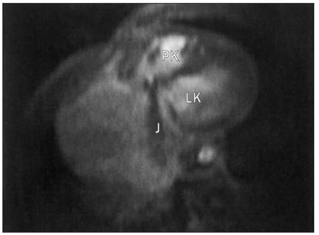Gradient echo MRI v transaxiální rovině. Ve směru od trikuspidální chlopně do obrovské pravé síně vidíme ztrátu signálu (trikuspidální regurgitace).