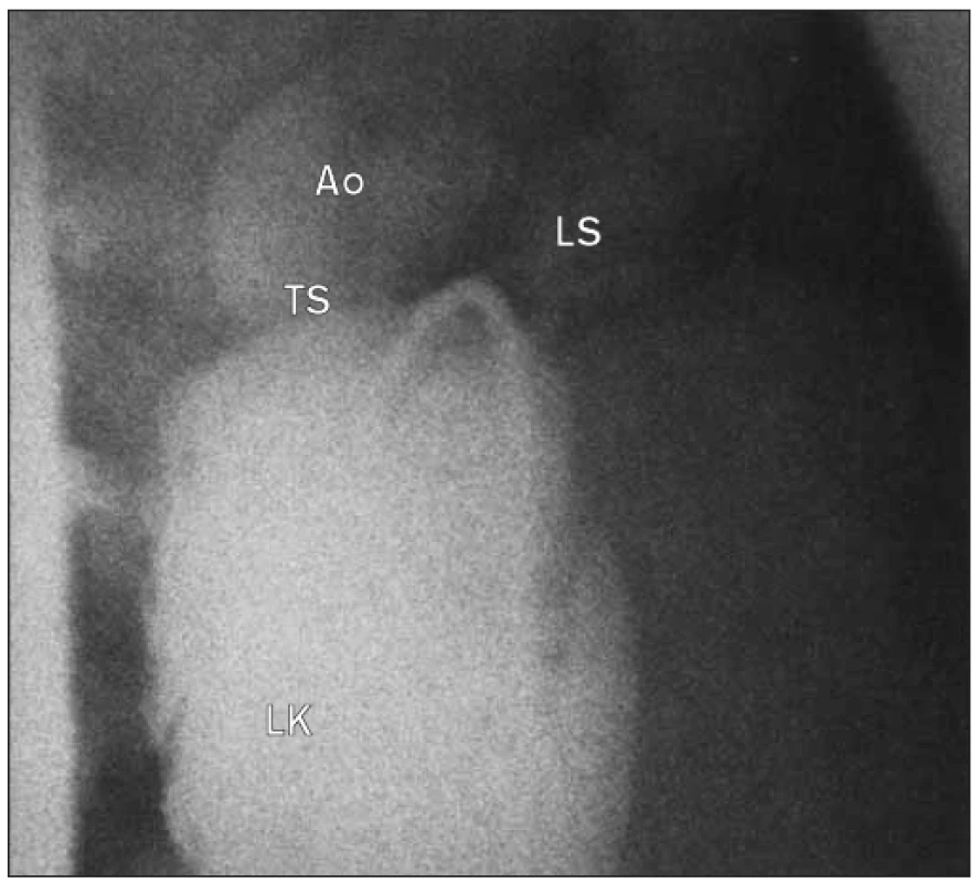 Angiogram levé komory u tunelové subaortální stenózy. Subaortální „přepážka“