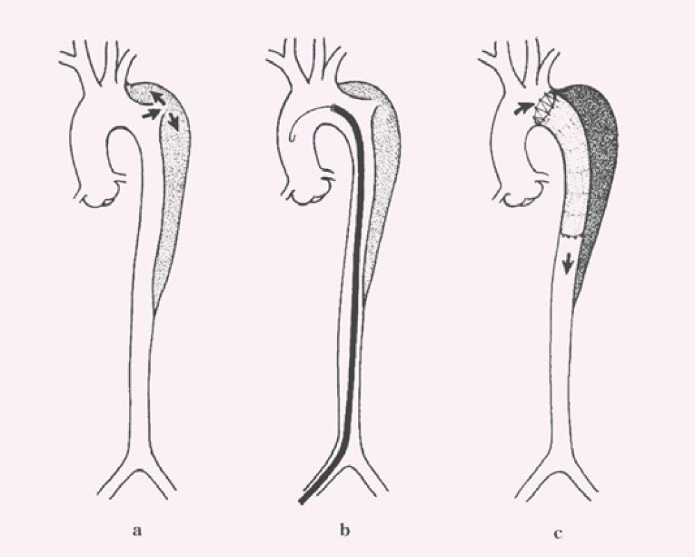 Schéma endovaskulární léčby disekce typu B: 
a) disekce B s primárním entry tear za levou podklíčkovou tepnou, b) stentgraft zavedený do oblasti primárního entry tear, c) implantace stentgraftu s překrytím primárního entry tear a navozením trombózy falešného kanálu v oblasti sestupné hrudní aorty.