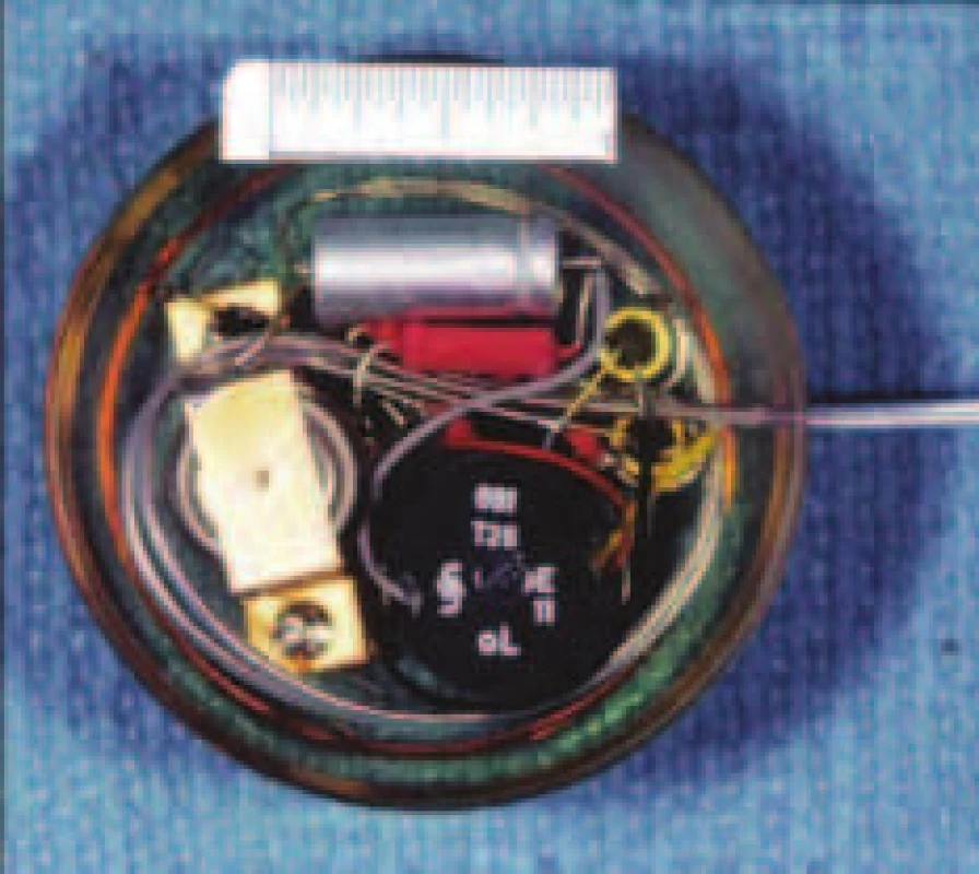 První prototyp implantovaného kardiostimulátoru byl implantován 8. října 1958. Autorem je R. Elmqvist.