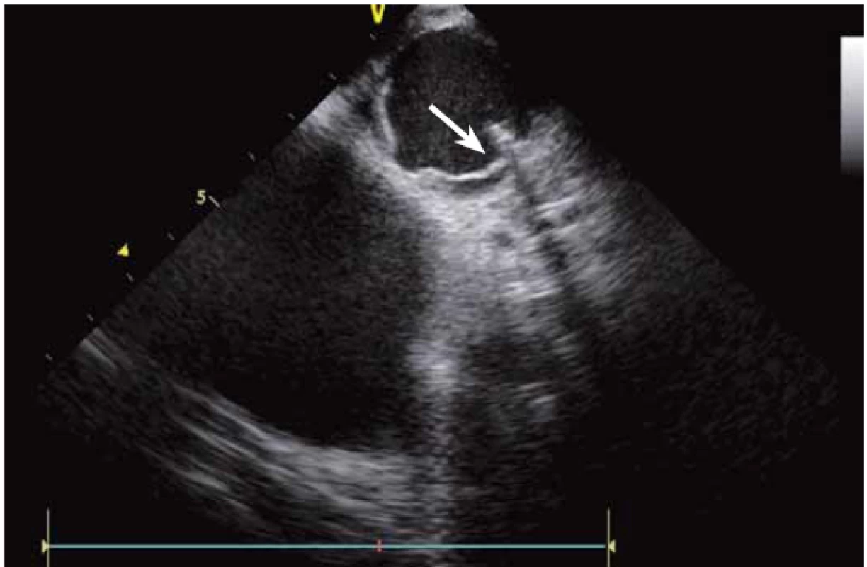 Ablace komorové extrasystolie z oblasti komisury levé a pravé koronární kapsičky aorty, hrot katetru zavedený retrográdně napřímo do oblasti komisury.