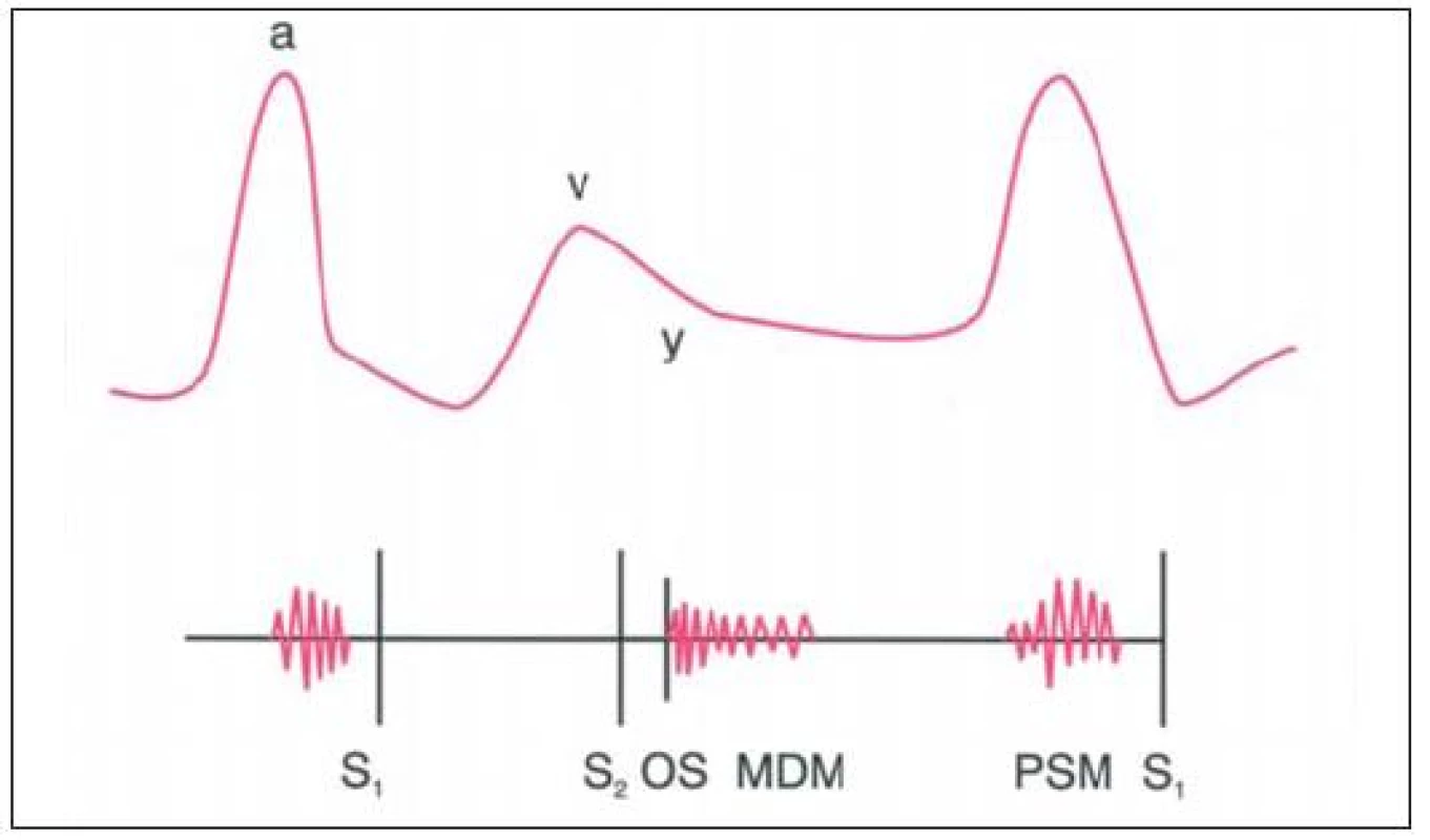 Schematická ilustrace důležitých fyzikálních nálezů u trikuspidální stenózy. Prominující vlna „a“, pomalý sestup „y“ a crescendo-decrescendo diastolický šelest, který zesiluje během inspirace. Může být též otevírací zvuk a presystolický šelest.