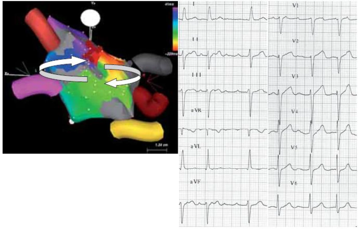 Povrchové EKG makroreentry síňové tachykardie po RF ablaci pro permanentní FiS (levý panel). Tachykardie využívá zónu pomalého vedení mezi kontralaterálními plicními žilami. Reentry okruh je naznačen šipkami. Šedě je zobrazena jizva (síňová tkáň kolem plicních žil po předchozích RF ablacích). Nejčasnější aktivace je zobrazena červenou barvou, nejpozdější pak purpurovou. Série ablačních lézí (cihlově červené tečky) terminovala arytmii, která následně nebyla vyvolatelná (pravý panel).