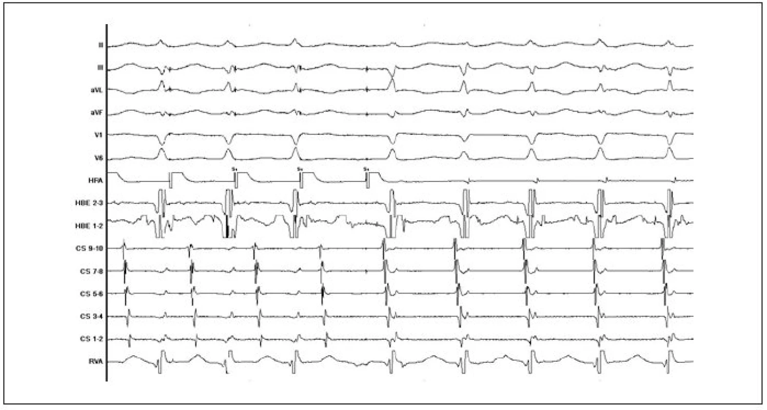 Ukázka indukce typické AVNRT v průběhu EFV při vzestupné stimulaci síní.