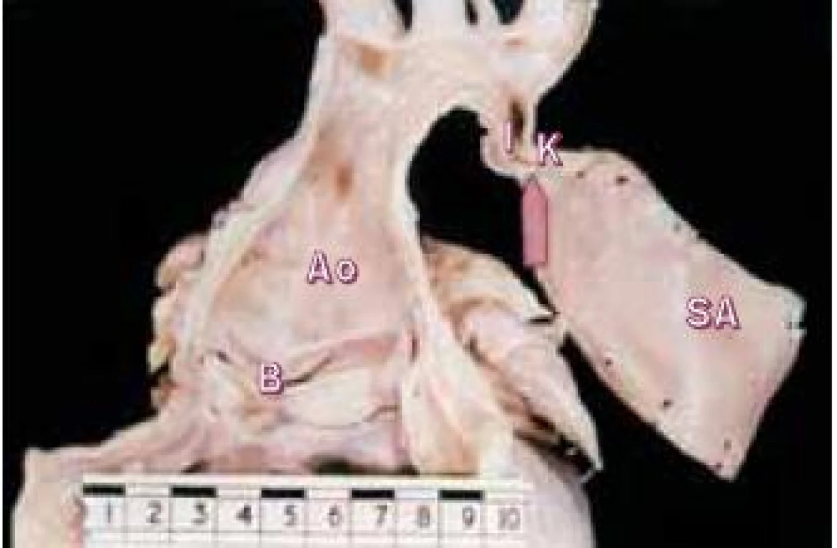 Pohled na tepny aortálního oblouku, koarktaci aorty s dilatací vzestupné aorty a na bikuspidální chlopeň aorty.