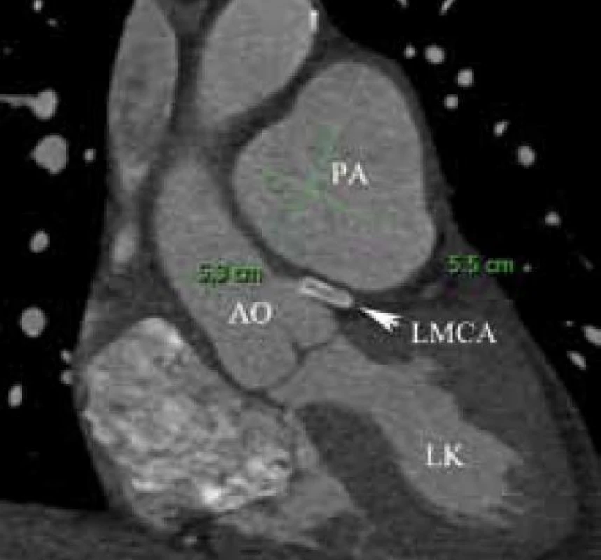 Uložení stentu a anatomické poměry v mediastinu z CT vyšetření srdce a věnčitých tepen.