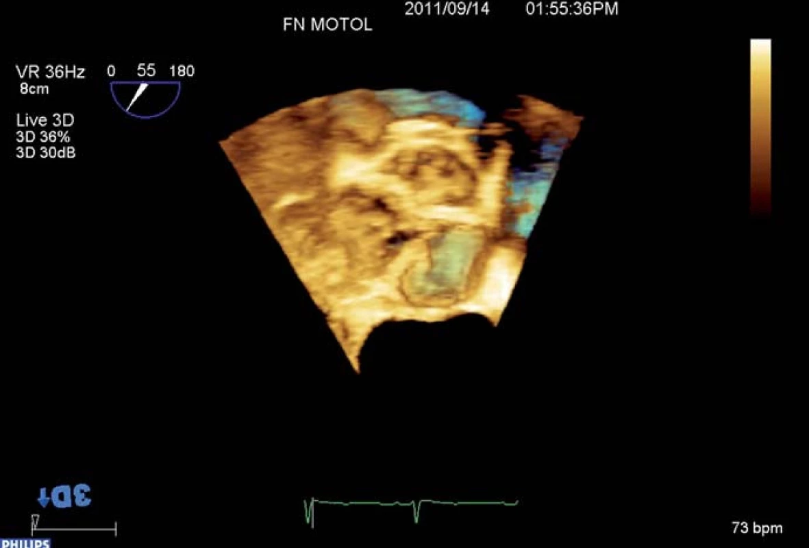 RT 3D TEE kalcifikované aortální stenózy.