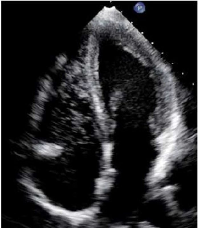 Echokardiografický obraz dusíkových bublin v pravostranných srdečních oddílech.