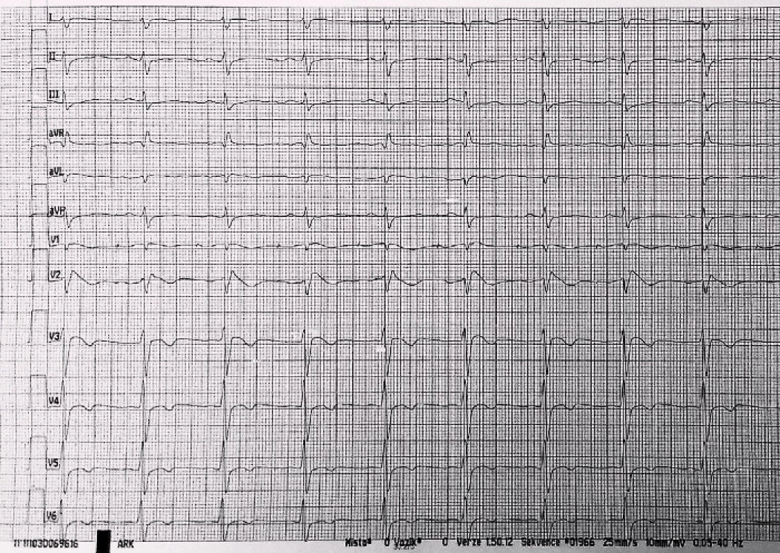 EKG po první resuscitaci pacientky, opět známky Brugada syndromu.