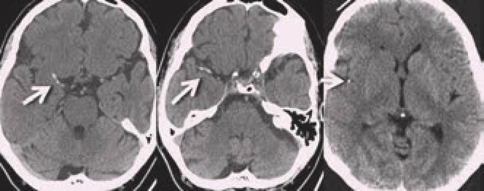 Nálezy trombů v ACM vpravo na nativním CT. Na posledním snímku je nález tzv. „dot sign“.
