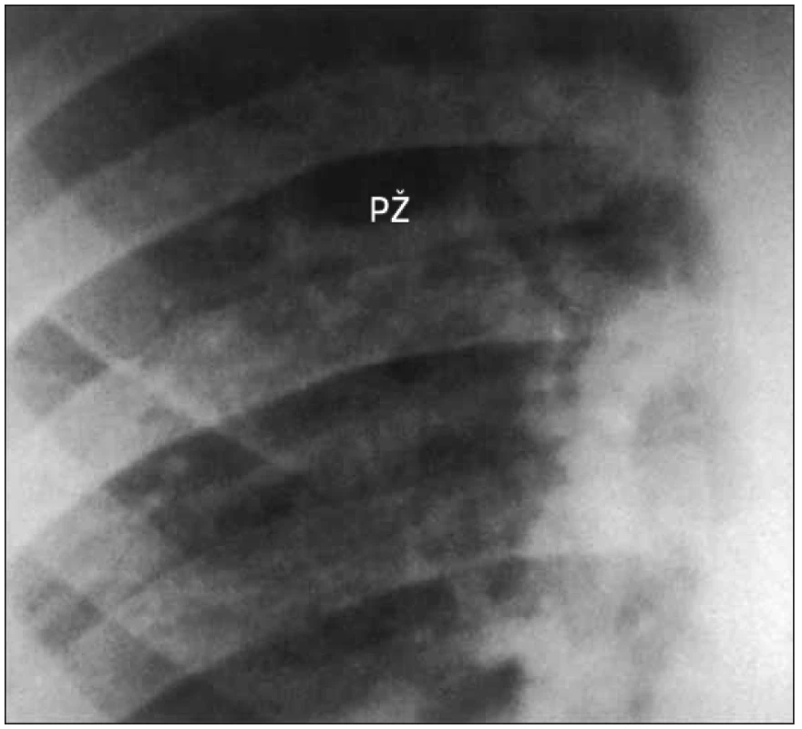 Skiagram ukazující vodorovné cévy nad pravým hilem poukazující na anomální plicní žílu.