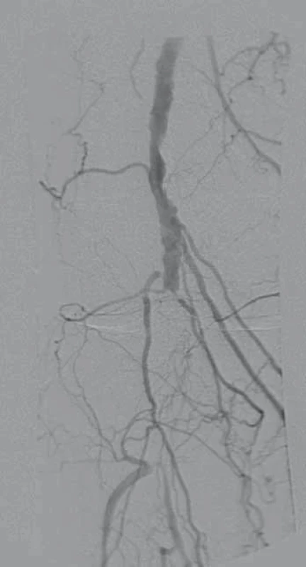 Uzávěr popliteální tepny PDK u pacienta s CLI v úseku P2–3 v angiografickém obraze.