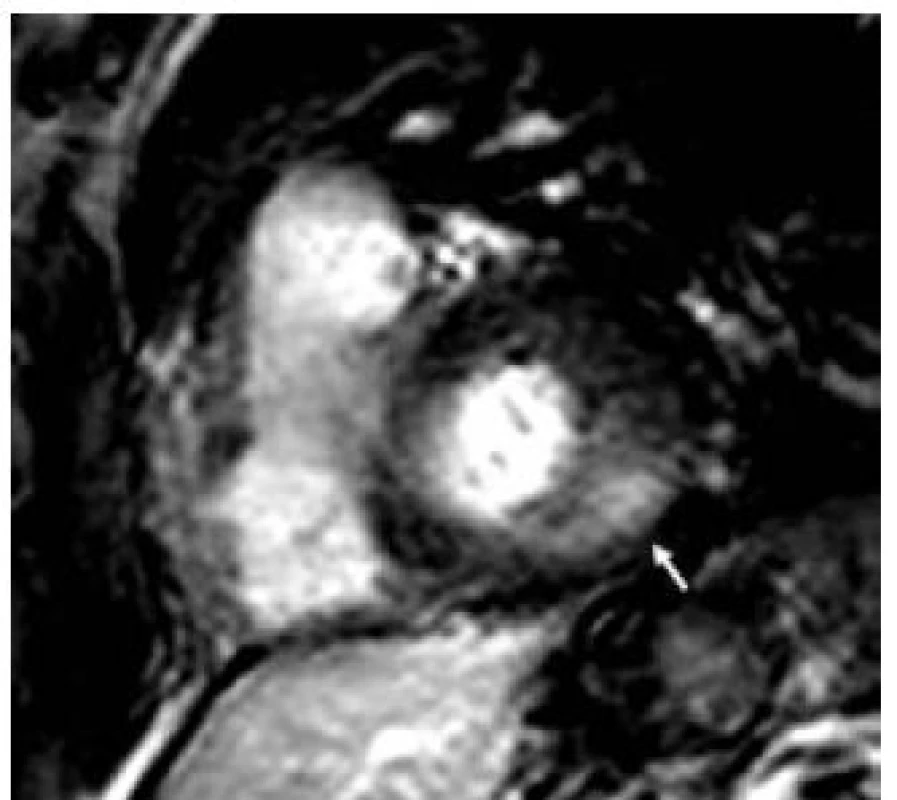 Pozdní sycení kontrastní látkou v midmyokardiální oblastu bazálního posterolaterálního segmentu levé komory (šipka) u nemocného s Fabryho chorobou při vyšetření magnetickou rezonancí (řez v krátké ose levé komory).