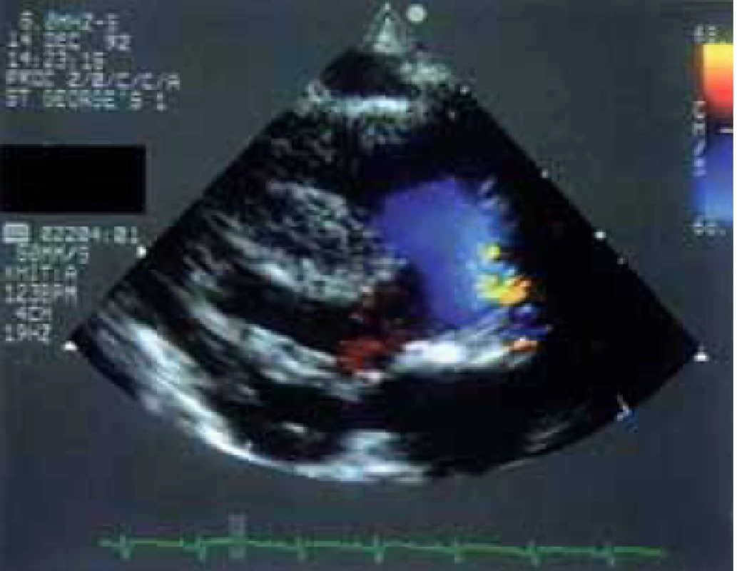 Parasternální pohled v dlouhé ose v barevném dopplerovském zobrazení ukazuje systolický výtok z obou komor do široké aorty, která nasedá na hypertrofické interventrikulární septum.