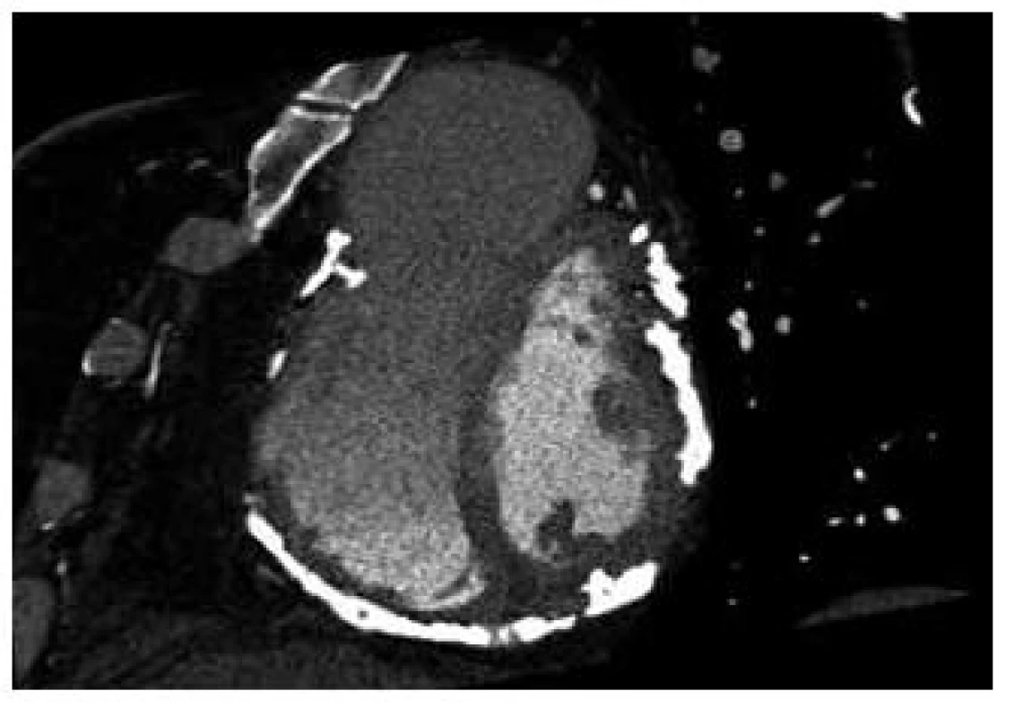 CT vyšetření srdce s masivními (svítícími) kalcinacemi v okolí obou srdečních komor.