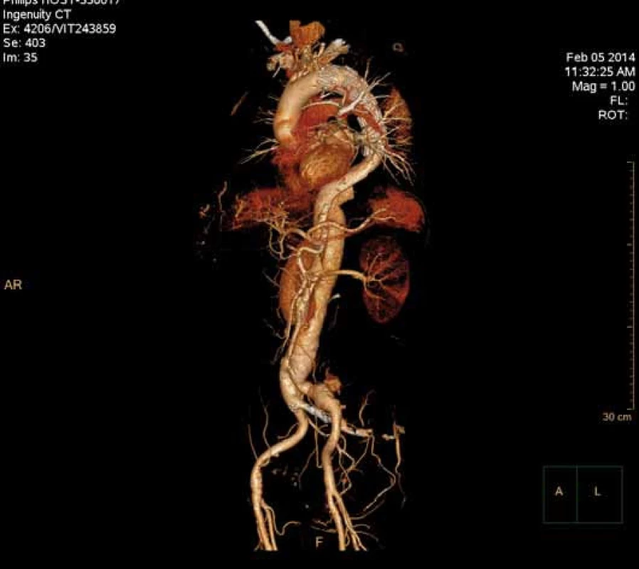 Speciální počítačové zpracování CT angiografie zvané Volume Rendering u pacienta prezentovaného na obr. 3 a 4.